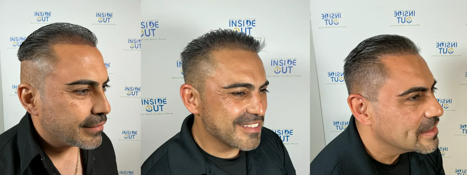 Hair Restoration — Hair Transformation — patient at Inside Out Medical Center, Fresno