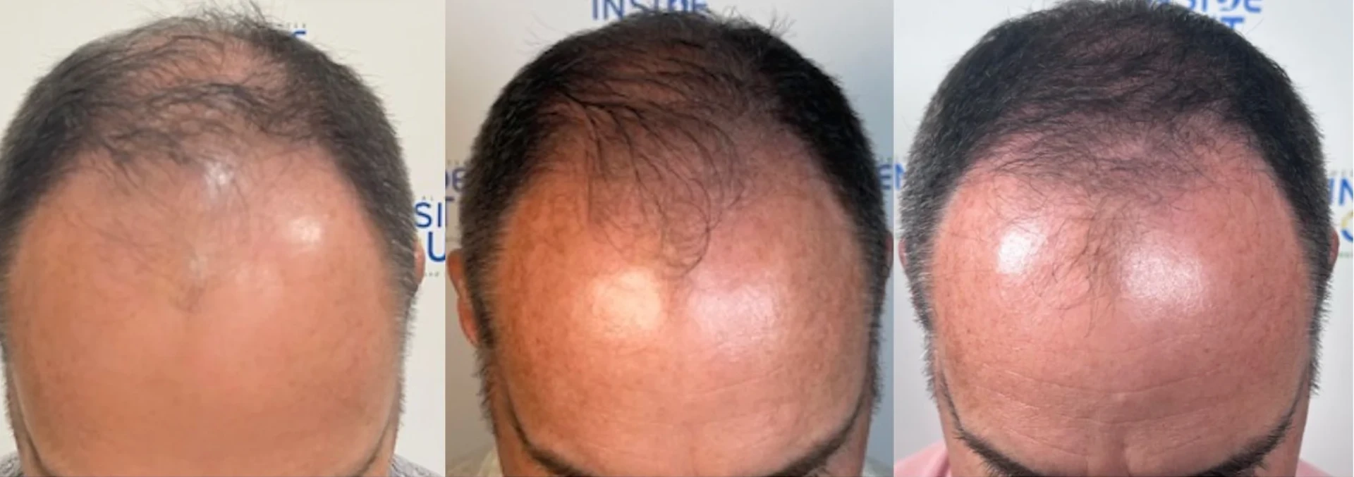 Hair Restoration — Hair Transformation — patient at Inside Out Medical Center, Fresno
