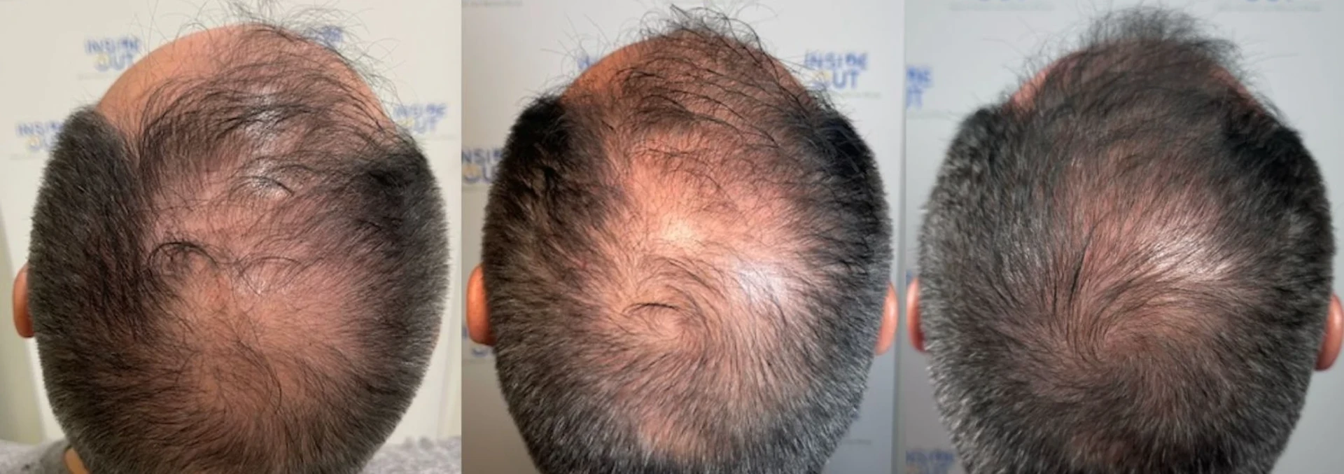 Hair Restoration — Hair Transformation — patient at Inside Out Medical Center, Fresno