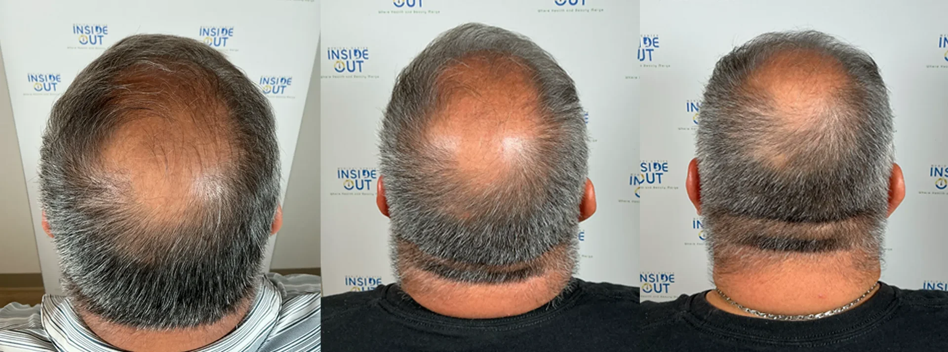 Hair Restoration — Hair Transformation — patient at Inside Out Medical Center, Fresno
