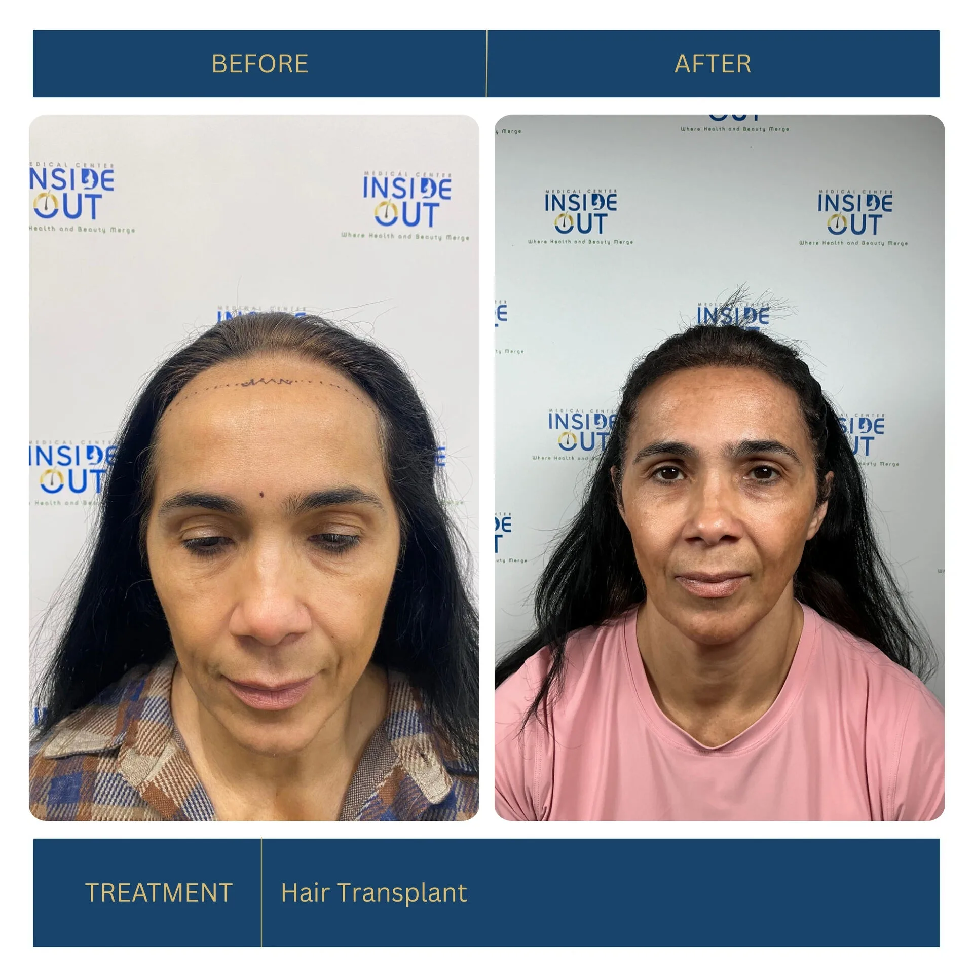 Before and after FUE hair transplant