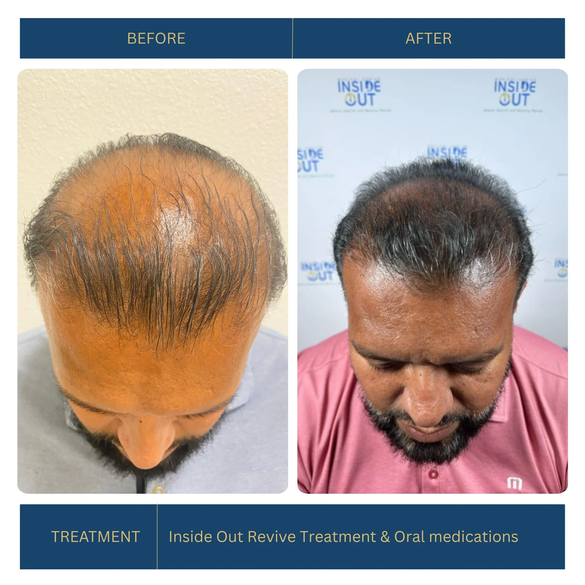 Before and after FUE hair transplant