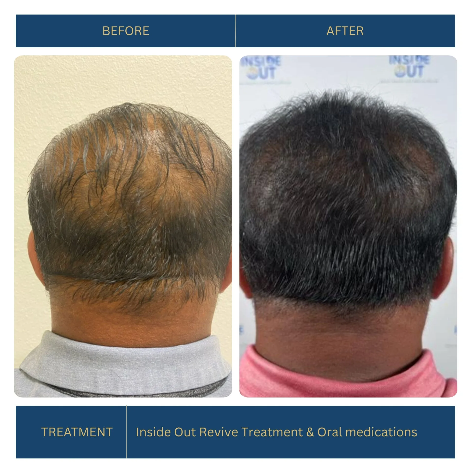 Before and after FUE hair transplant