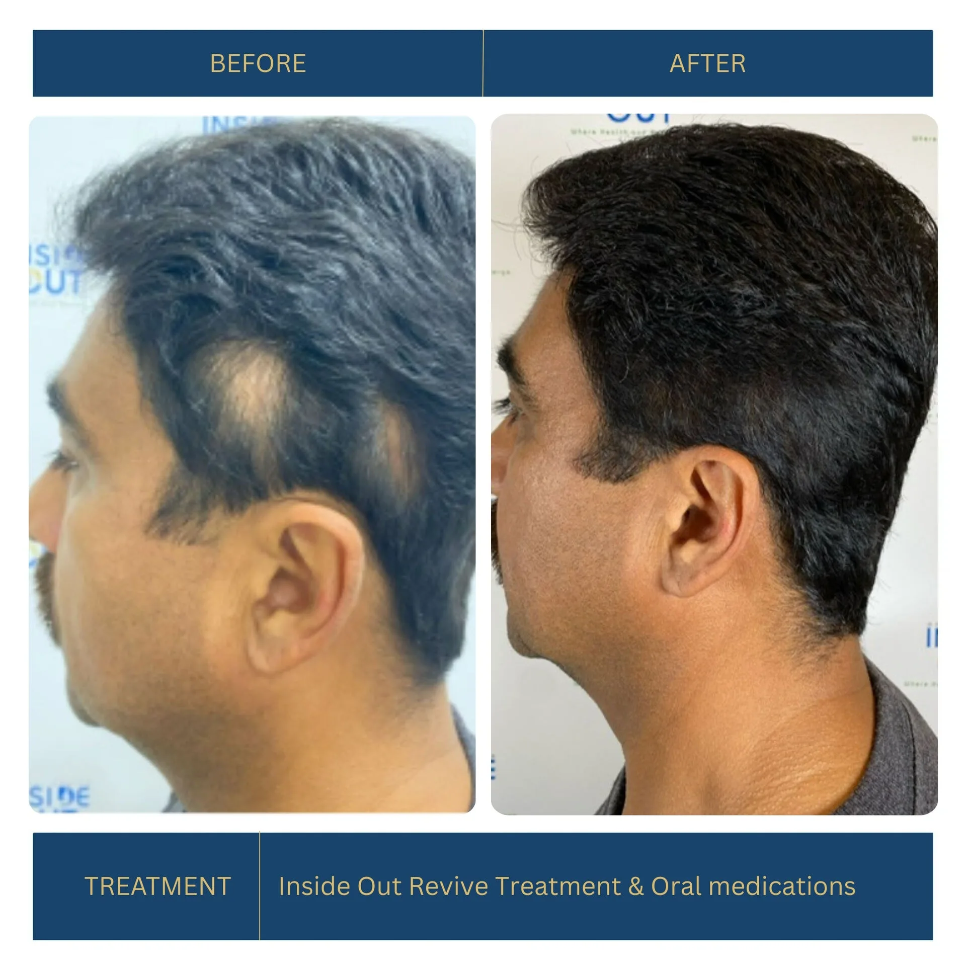 Before and after FUE hair transplant
