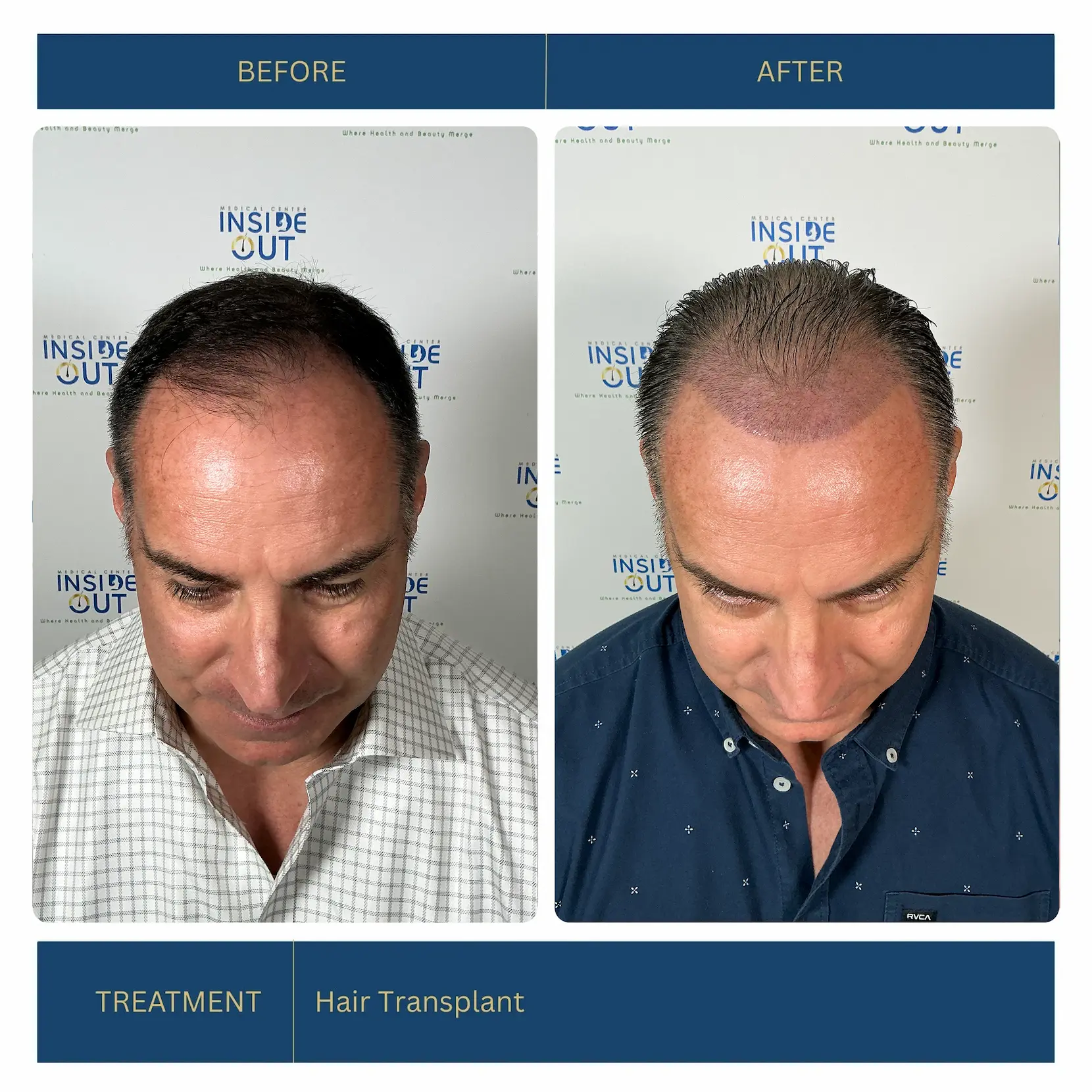 Hair Transplant — Hairline restoration — patient at Inside Out Medical Center, Fresno