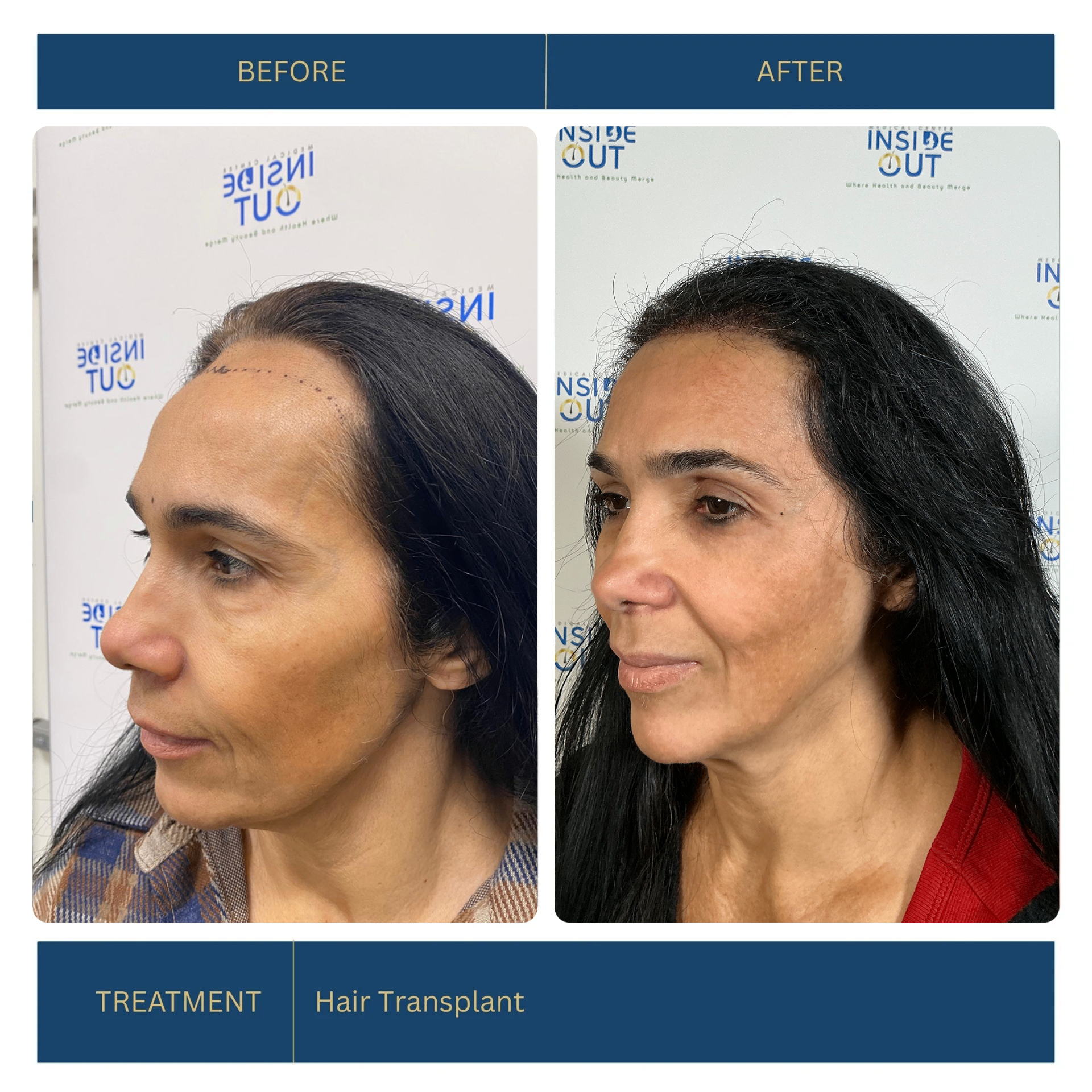 Hair Transplant — Hairline restoration — patient at Inside Out Medical Center, Fresno