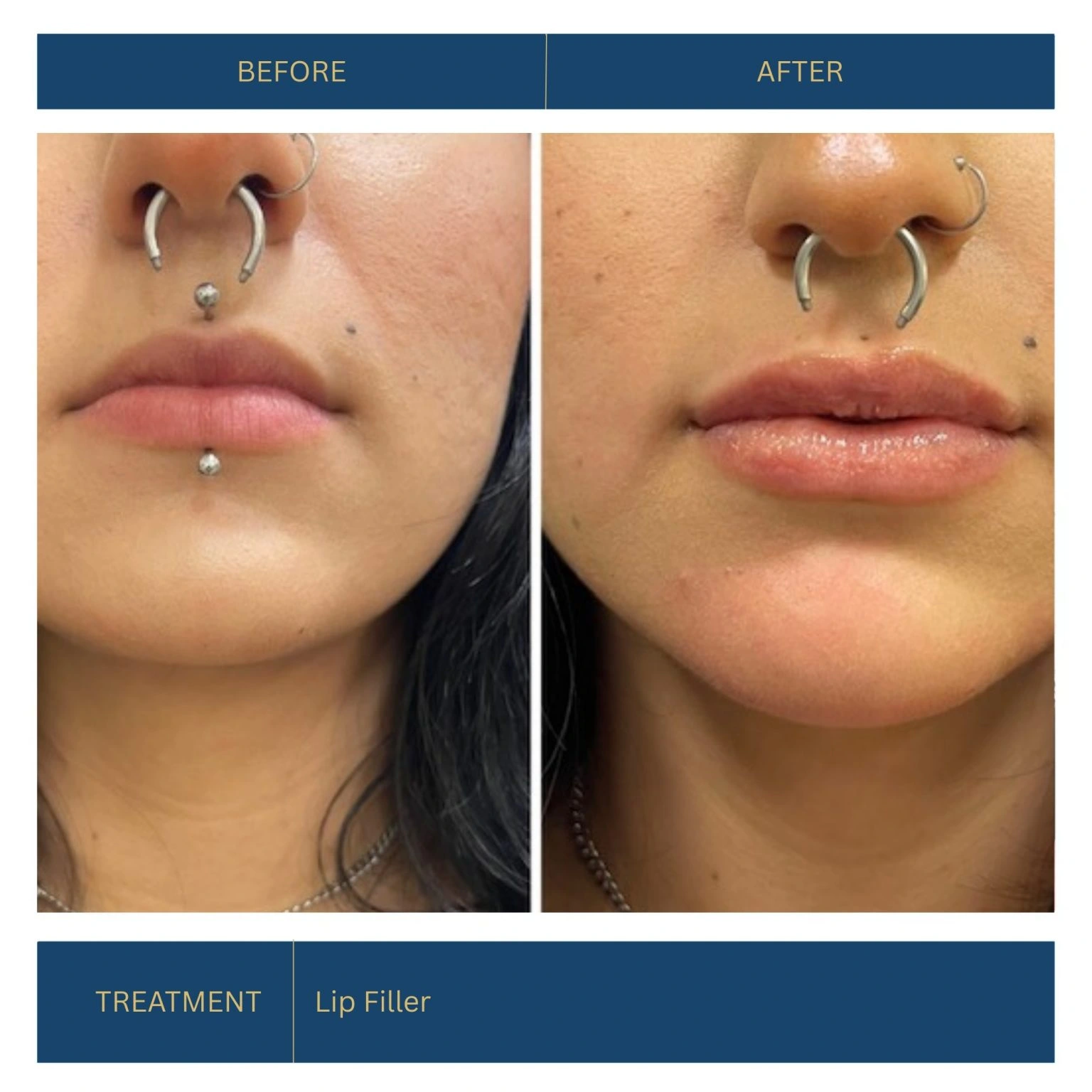 Lip Filler — Lip enhancement — patient at Inside Out Medical Center, Fresno