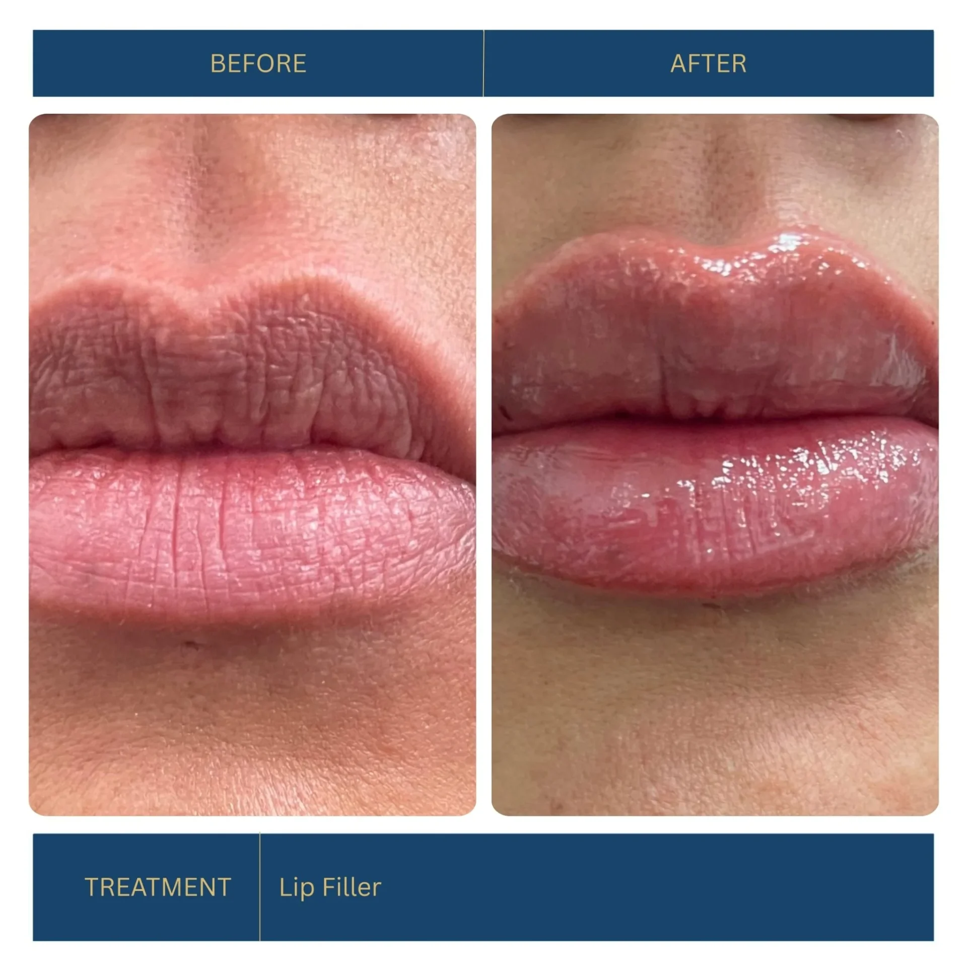 Lip Filler — Lip enhancement — patient at Inside Out Medical Center, Fresno