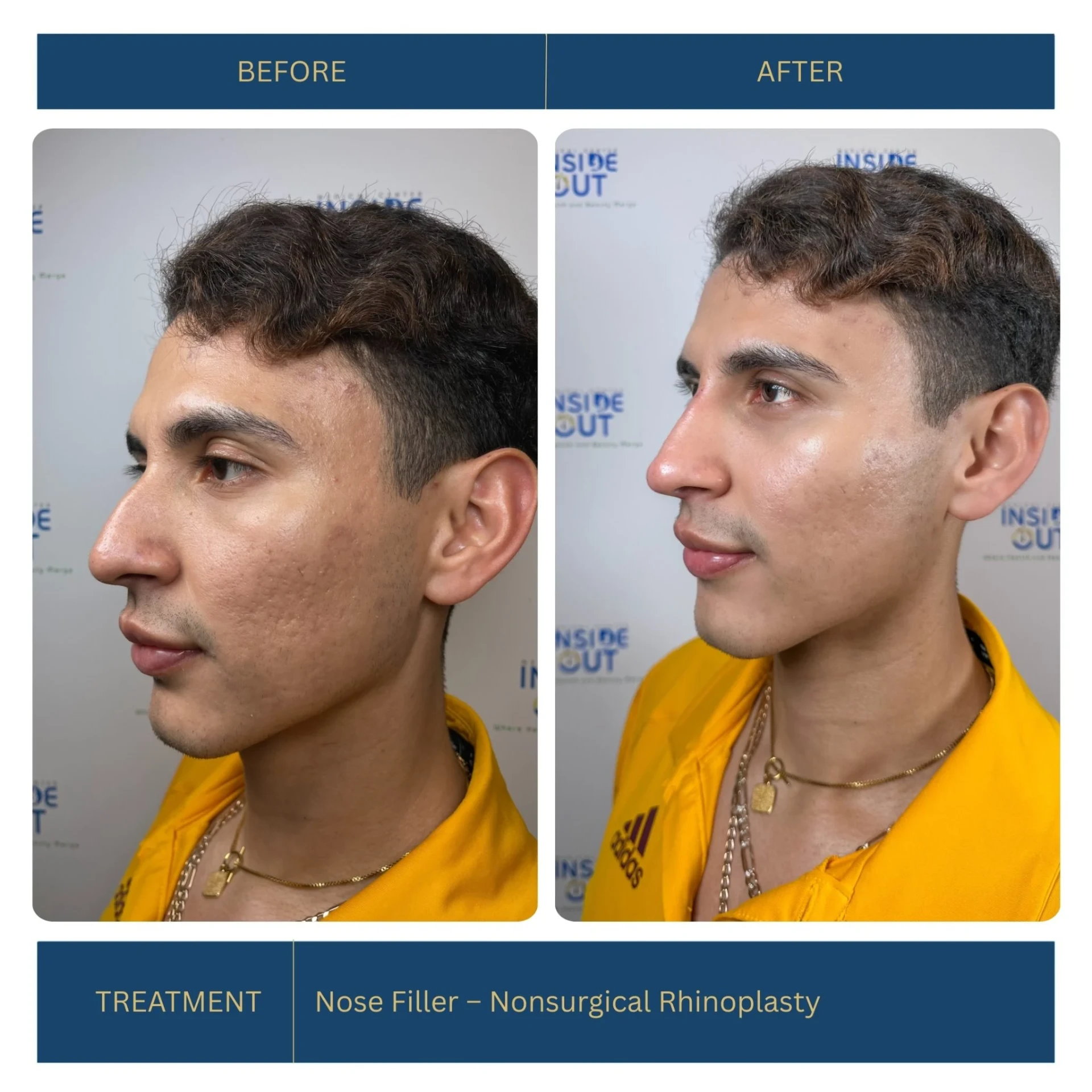 Nose Filler — Nonsurgical Rhinoplasty — Nose contouring — patient at Inside Out Medical Center, Fresno