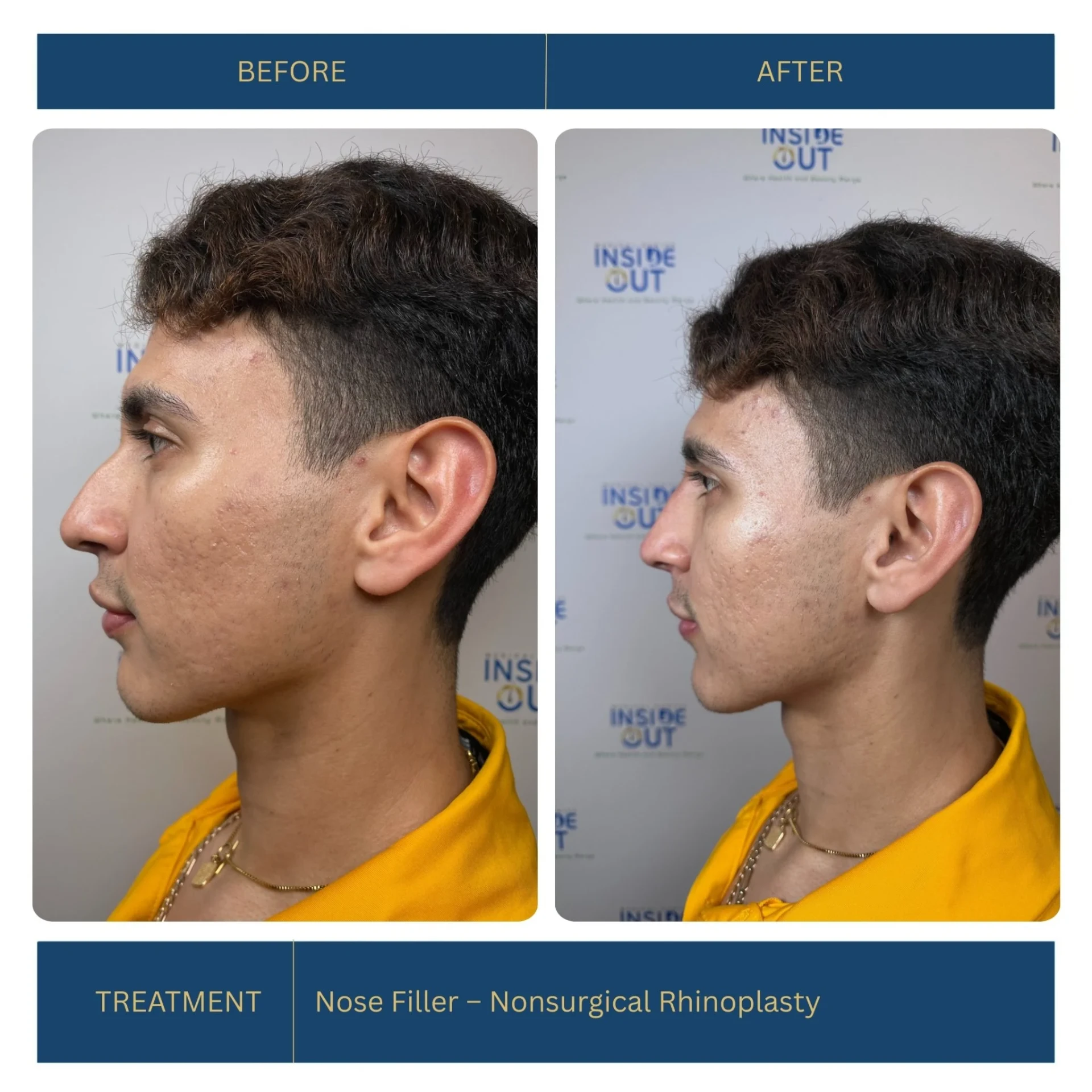 Nose Filler — Nonsurgical Rhinoplasty — Nose contouring — patient at Inside Out Medical Center, Fresno