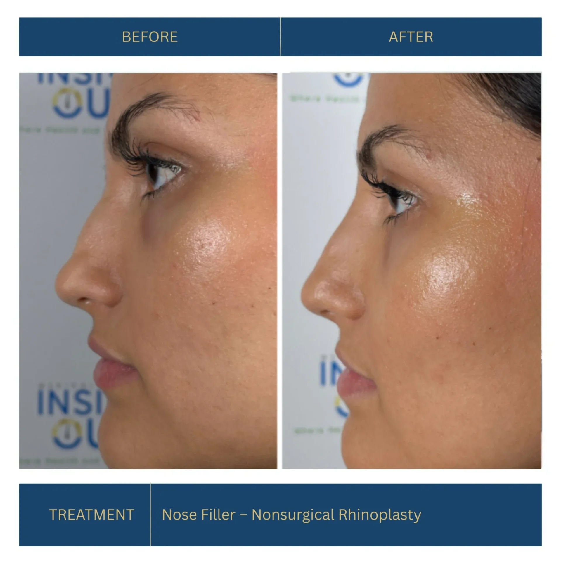 Nose Filler — Nonsurgical Rhinoplasty — Nose contouring — patient at Inside Out Medical Center, Fresno