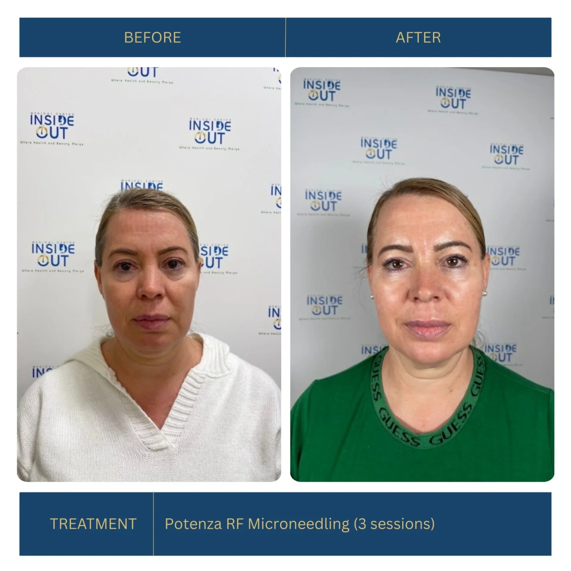 Potenza RF Microneedling — Full-face rejuvenation — patient at Inside Out Medical Center, Fresno