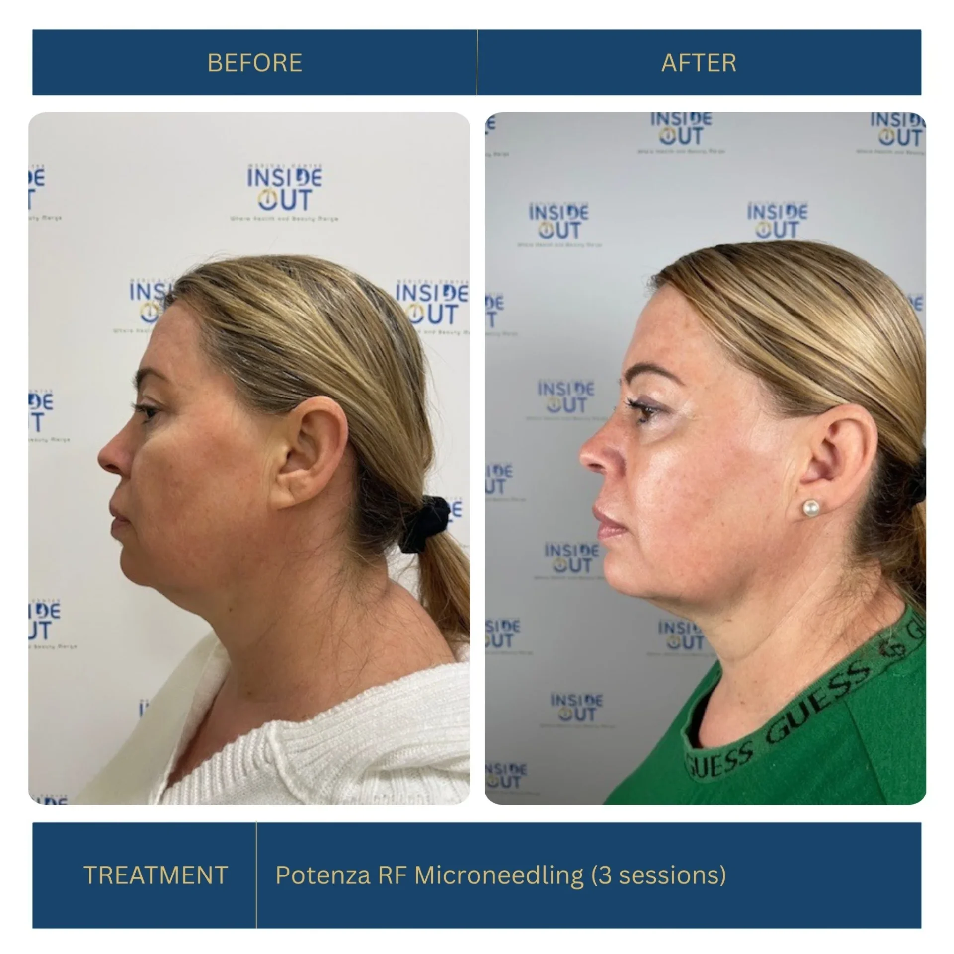 Potenza RF Microneedling — Full-face rejuvenation — patient at Inside Out Medical Center, Fresno