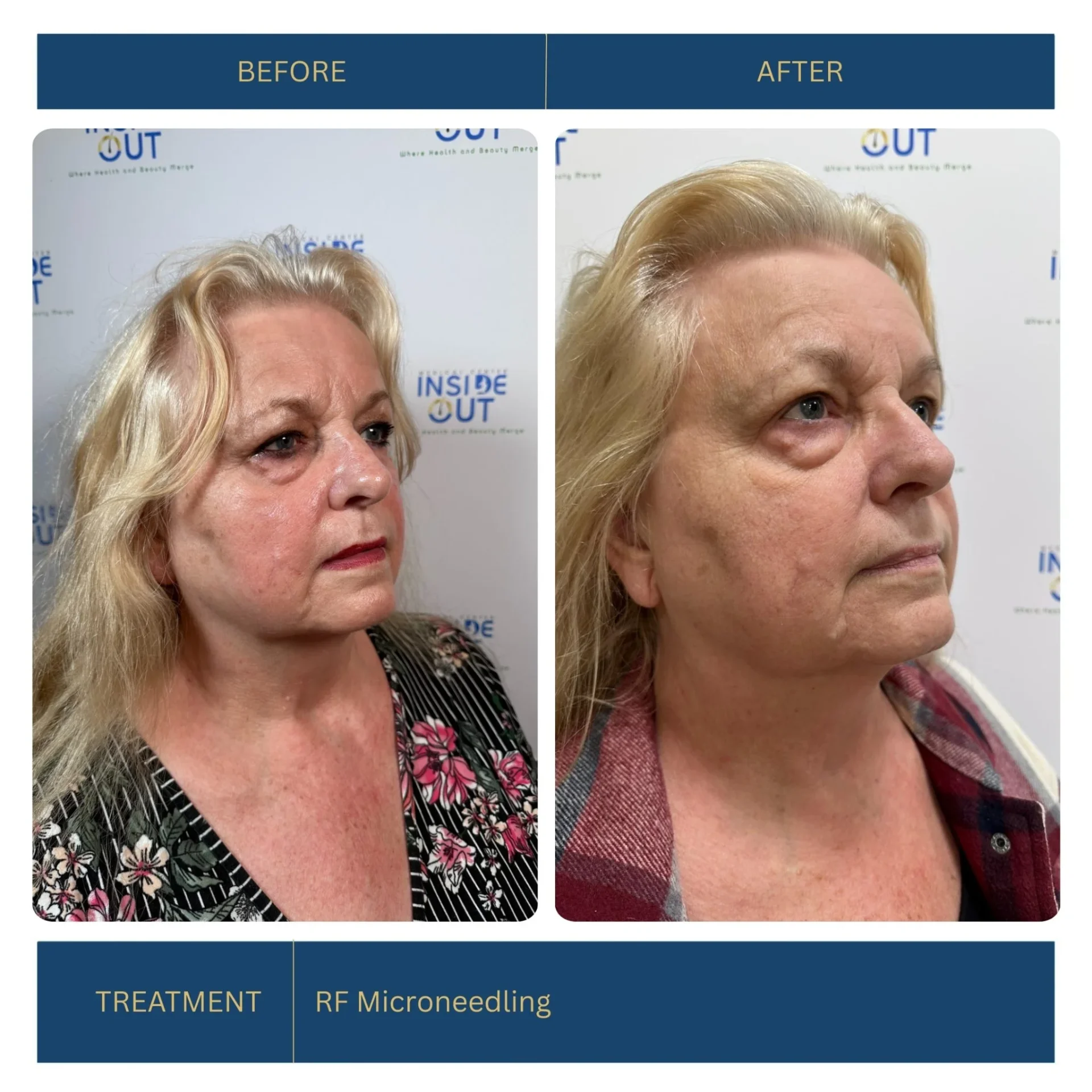 RF Microneedling — Skin tightening & resurfacing — patient at Inside Out Medical Center, Fresno
