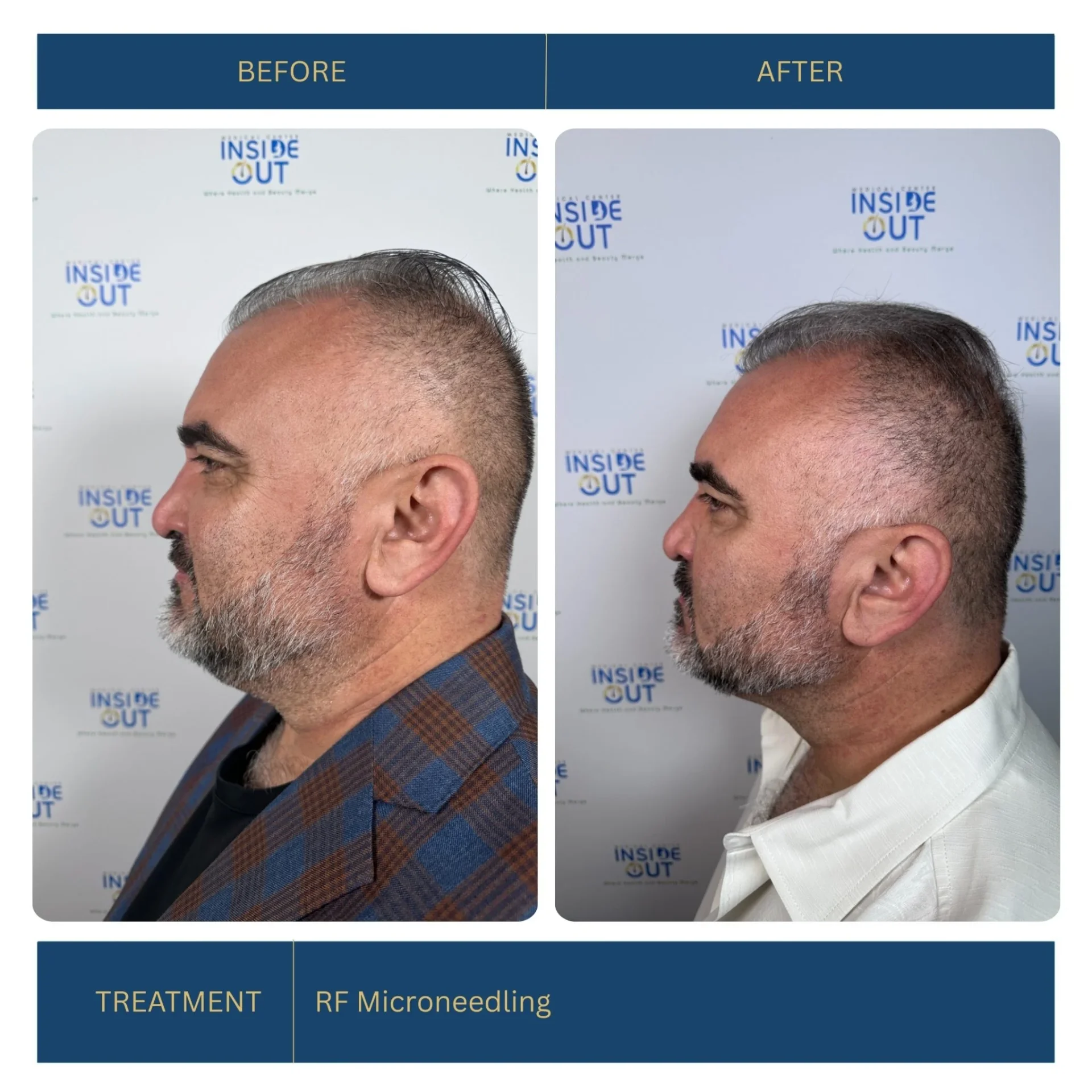RF Microneedling — Skin tightening & resurfacing — patient at Inside Out Medical Center, Fresno