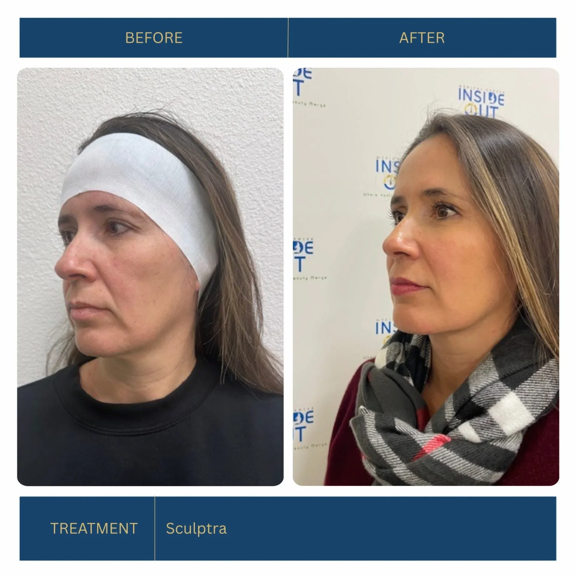 Sculptra — Collagen-stimulating biostimulator — patient at Inside Out Medical Center, Fresno