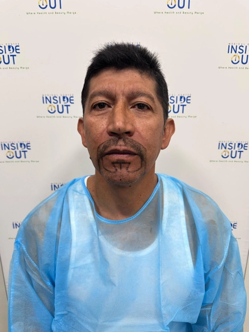 Beard Transplant — Facial hair restoration — patient at Inside Out Medical Center, Fresno