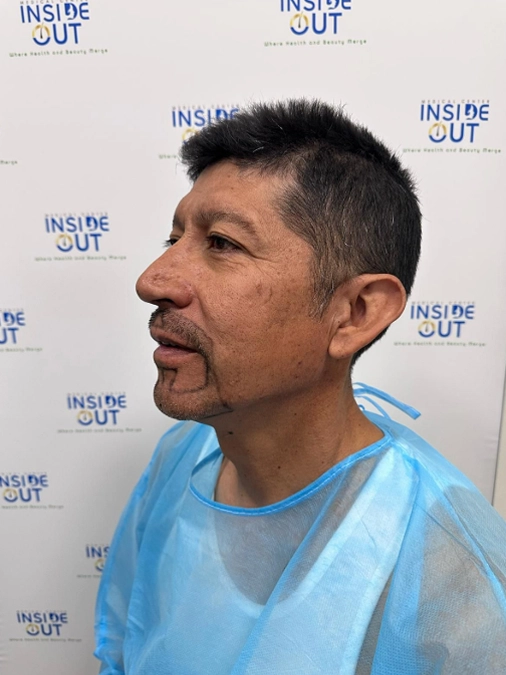 Beard Transplant — Facial hair restoration — patient at Inside Out Medical Center, Fresno