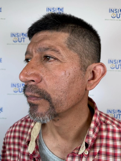 Beard Transplant — Facial hair restoration — patient at Inside Out Medical Center, Fresno