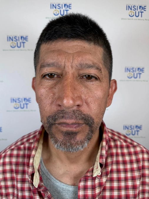 Beard Transplant — Facial hair restoration — patient at Inside Out Medical Center, Fresno