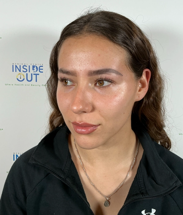 Eyebrow Transplant — Shape & density — patient at Inside Out Medical Center, Fresno