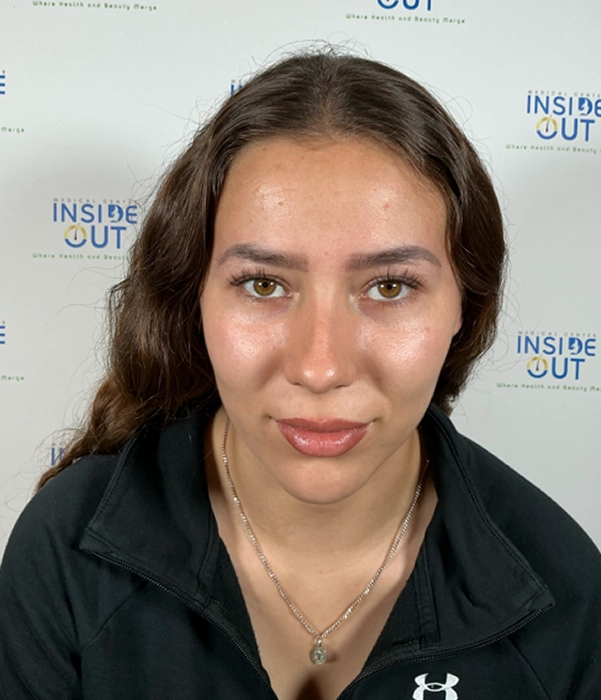 Eyebrow Transplant — Shape & density — patient at Inside Out Medical Center, Fresno