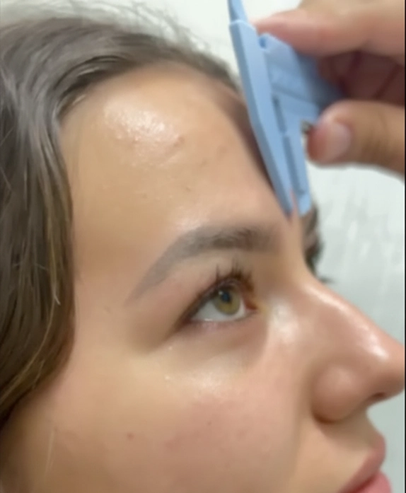 Eyebrow Transplant — Brow design & mapping — patient at Inside Out Medical Center, Fresno