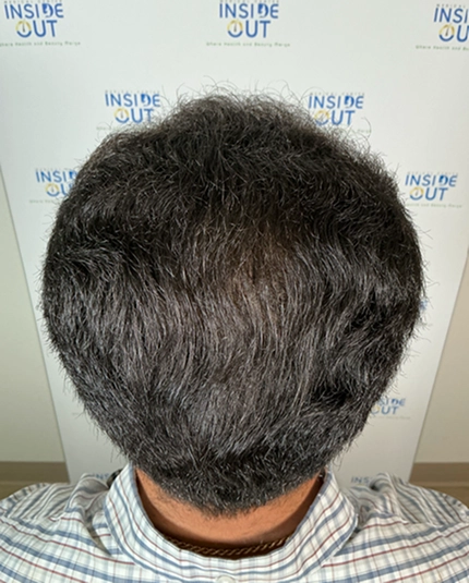 Hair Transplant and Restoration — — patient at Inside Out Medical Center, Fresno