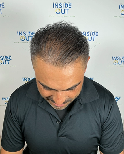 Hair Transplant and Restoration — — patient at Inside Out Medical Center, Fresno