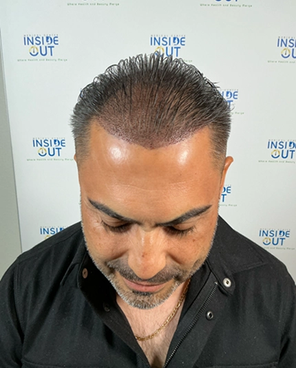 Hair Transplant and Restoration — — patient at Inside Out Medical Center, Fresno