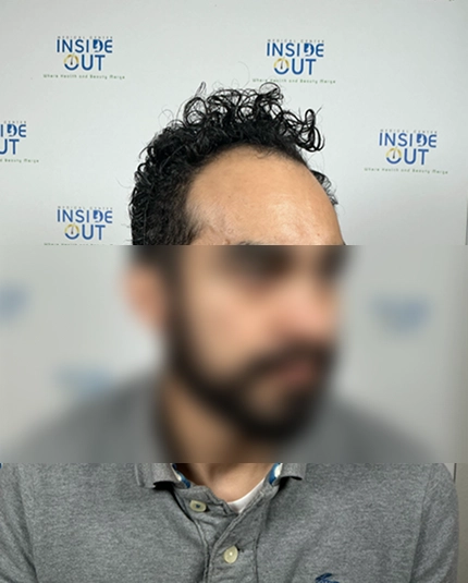 Hair Transplant and Restoration — — patient at Inside Out Medical Center, Fresno
