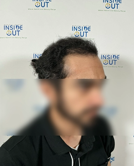 Hair Transplant and Restoration — — patient at Inside Out Medical Center, Fresno