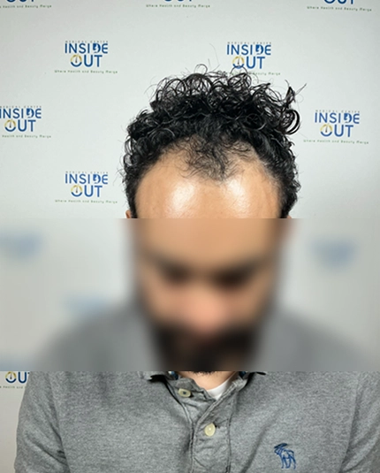 Hair Transplant and Restoration — — patient at Inside Out Medical Center, Fresno