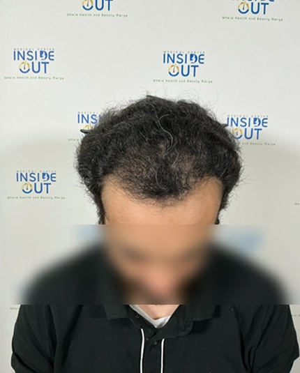 Hair Transplant and Restoration — — patient at Inside Out Medical Center, Fresno