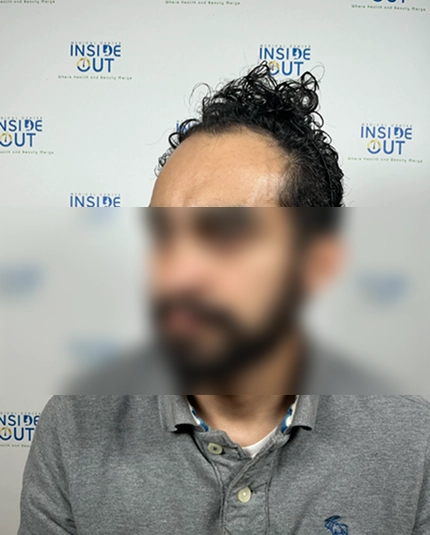 Hair Transplant and Restoration — — patient at Inside Out Medical Center, Fresno