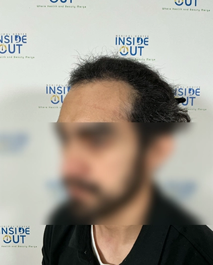 Hair Transplant and Restoration — — patient at Inside Out Medical Center, Fresno
