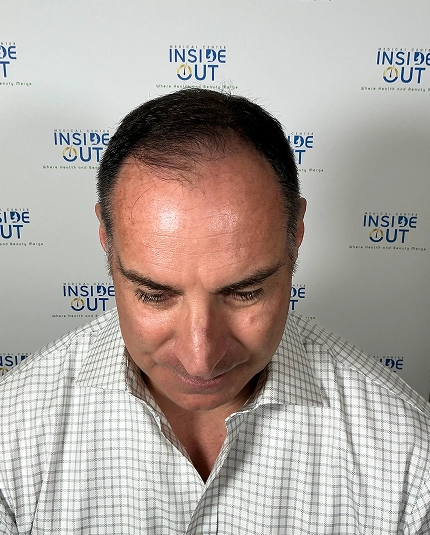 Hair Transplant and Restoration — — patient at Inside Out Medical Center, Fresno