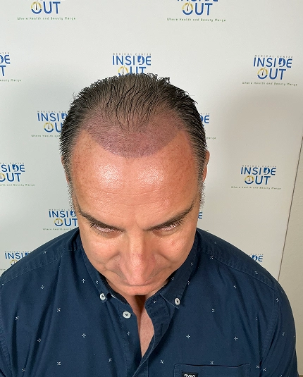 Hair Transplant and Restoration — — patient at Inside Out Medical Center, Fresno