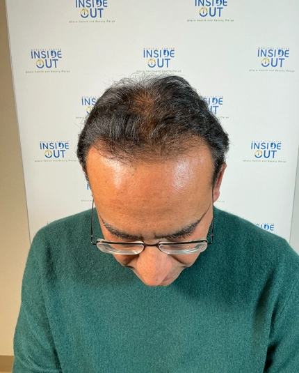 Hair Transplant and Restoration — — patient at Inside Out Medical Center, Fresno