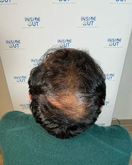 Hair Transplant and Restoration — — patient at Inside Out Medical Center, Fresno
