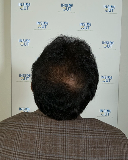 Hair Transplant and Restoration — — patient at Inside Out Medical Center, Fresno