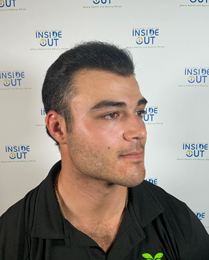 Hair Transplant and Restoration — — patient at Inside Out Medical Center, Fresno
