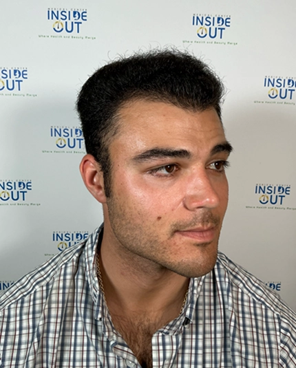 Hair Transplant and Restoration — — patient at Inside Out Medical Center, Fresno