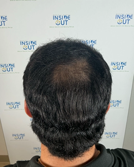 Hair Transplant and Restoration — — patient at Inside Out Medical Center, Fresno