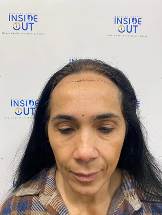 Women's Hair Transplant — Female hair restoration — patient at Inside Out Medical Center, Fresno