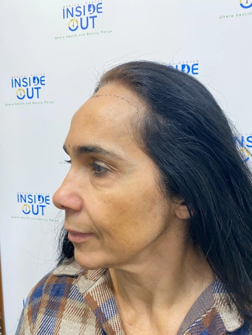 Women's Hair Transplant — Female hair restoration — patient at Inside Out Medical Center, Fresno