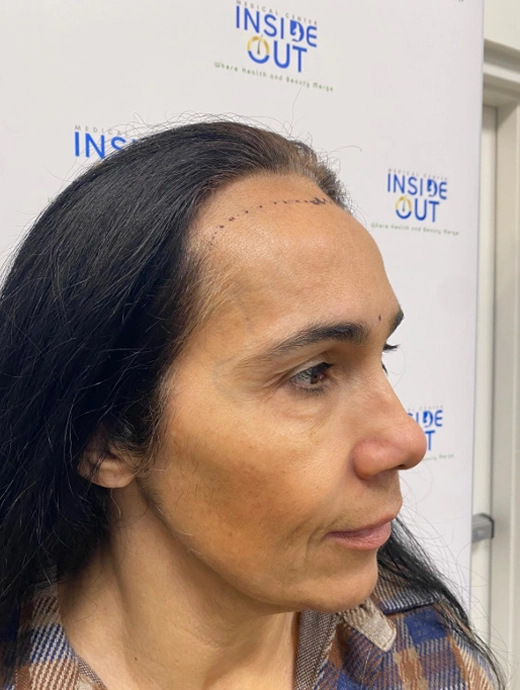 Women's Hair Transplant — Female hair restoration — patient at Inside Out Medical Center, Fresno