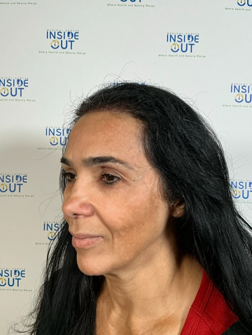 Women's Hair Transplant — Female hair restoration — patient at Inside Out Medical Center, Fresno