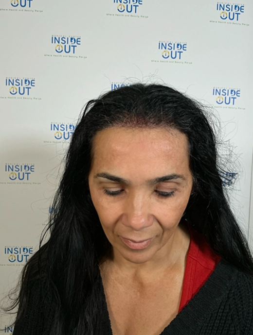 Women's Hair Transplant — Female hair restoration — patient at Inside Out Medical Center, Fresno
