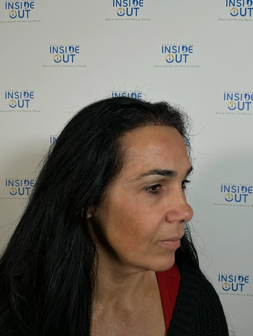 Women's Hair Transplant — Female hair restoration — patient at Inside Out Medical Center, Fresno